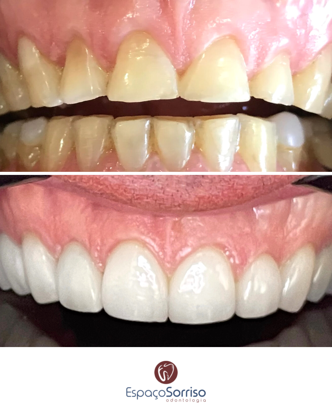 Facetas em Resina Espaço Sorriso Clinica de Odontologia